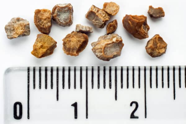 How to treat kidney stones naturally