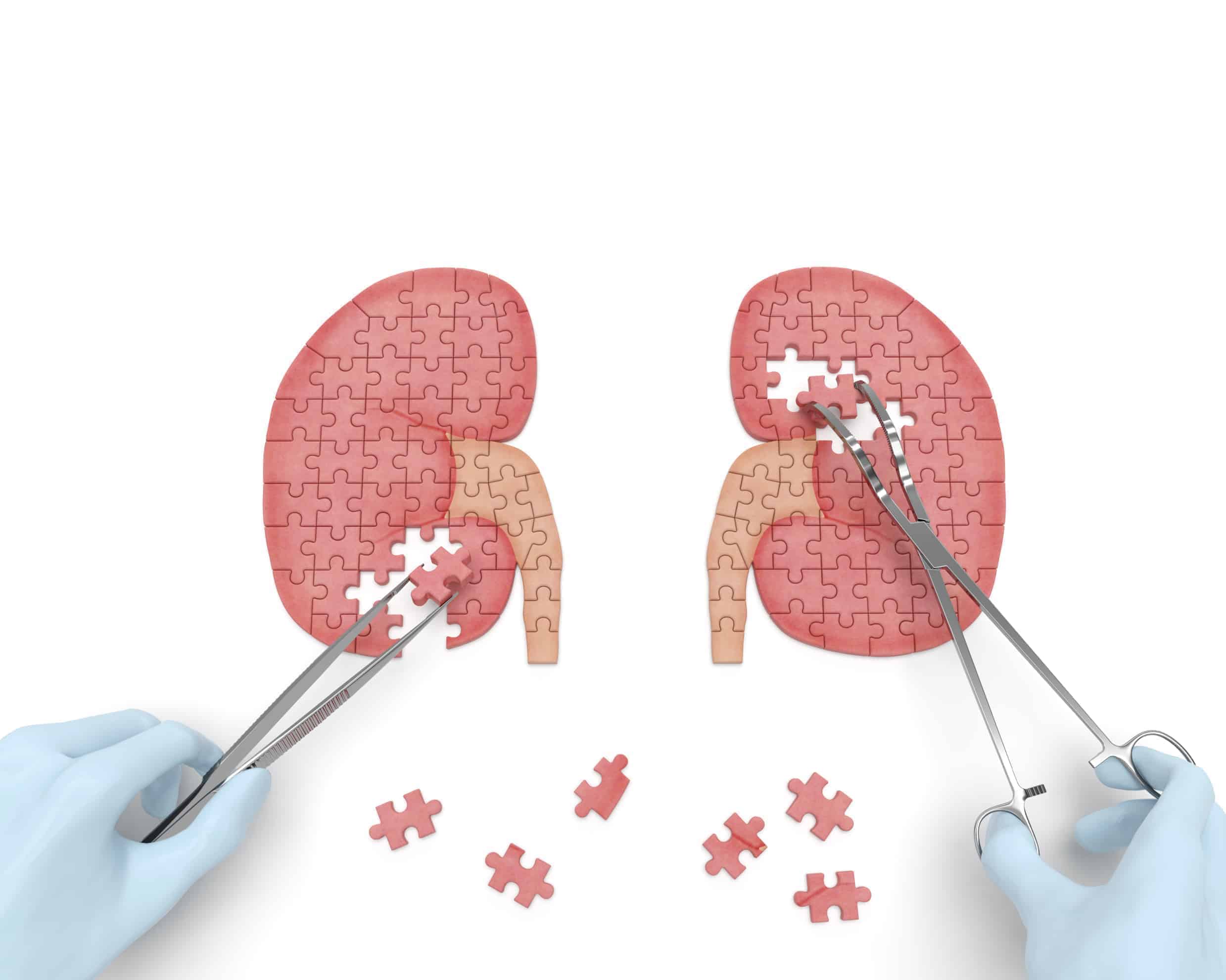 causes of CKD, causes of renal failure, causes of kidney disease, what causes kidney disease, what causes CKD, do I have CKD